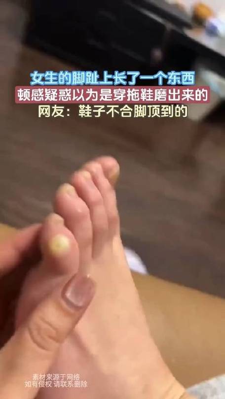 女生的脚趾上长了一个东西顿感疑惑以为是穿拖鞋磨出来的鞋子不合脚