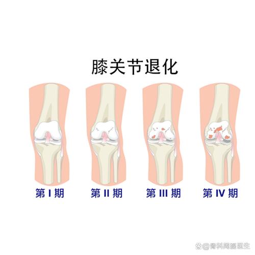 在某些情况下膝关节偶尔发出的咔咔响声可能是正常的生理现象这通