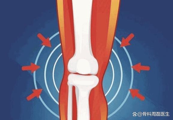 在某些情况下膝关节偶尔发出的咔咔响声可能是正常的生理现象这通